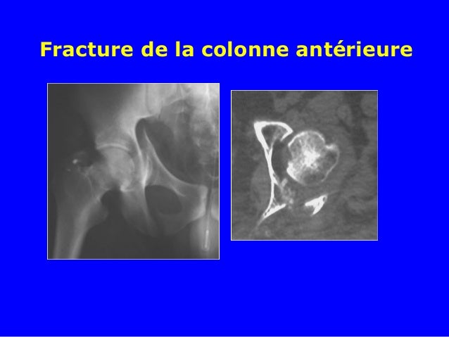 fracture du cotyle